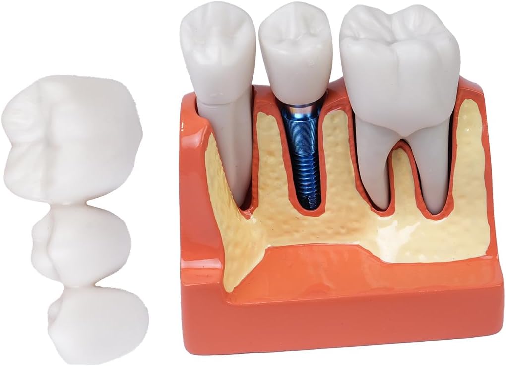 Sarini Modèle de dent buccale, modèle d'implant Dentaire avec Couronne et Pont Amovibles, adapté à la démonstration en Classe et à la Formation des étudiants en médecine Dentaire